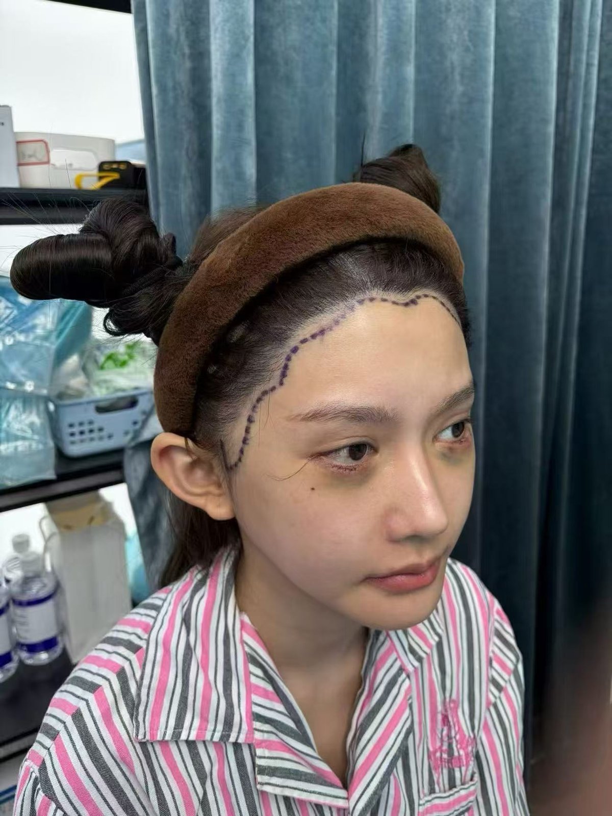 Client 1 before, three-quarter hairline view with clinical markings