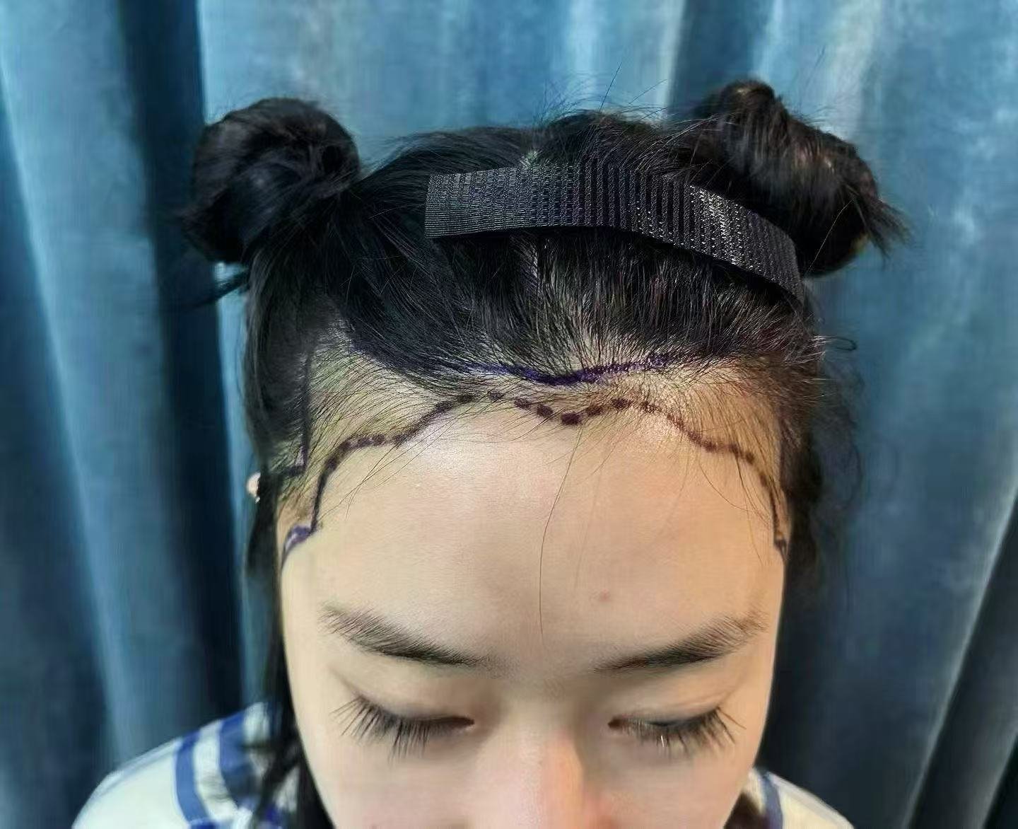 Client 2 before, frontal hairline with clinical markings