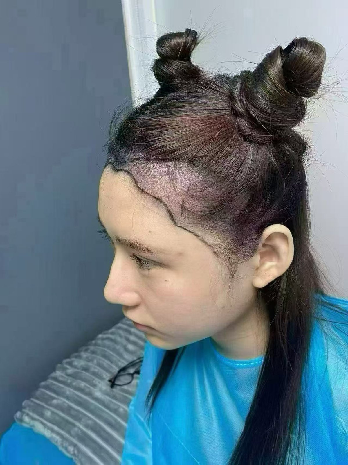 Client 2 before, left-side hairline with clinical markings