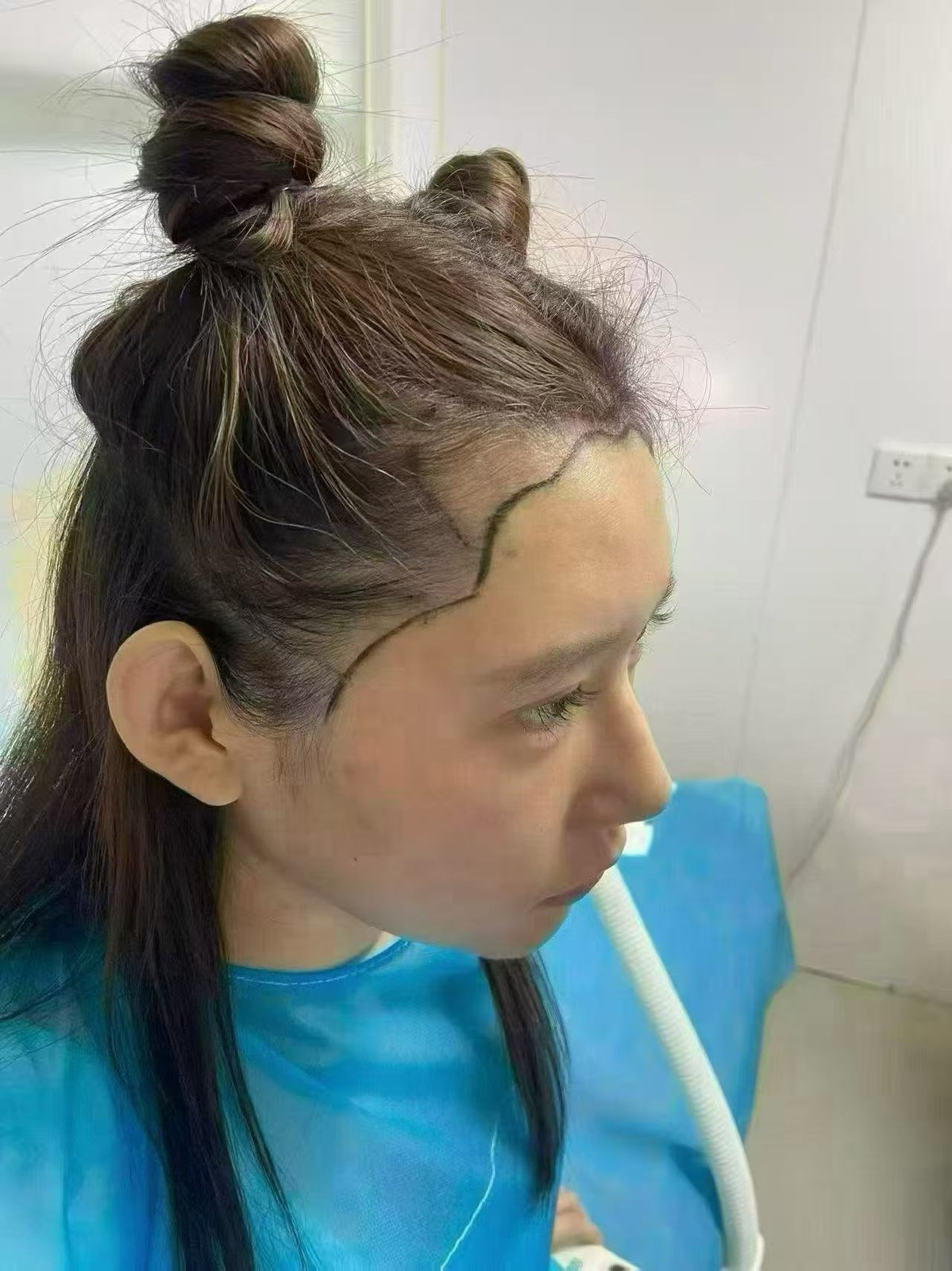 Client 2 before, right-side hairline with clinical markings