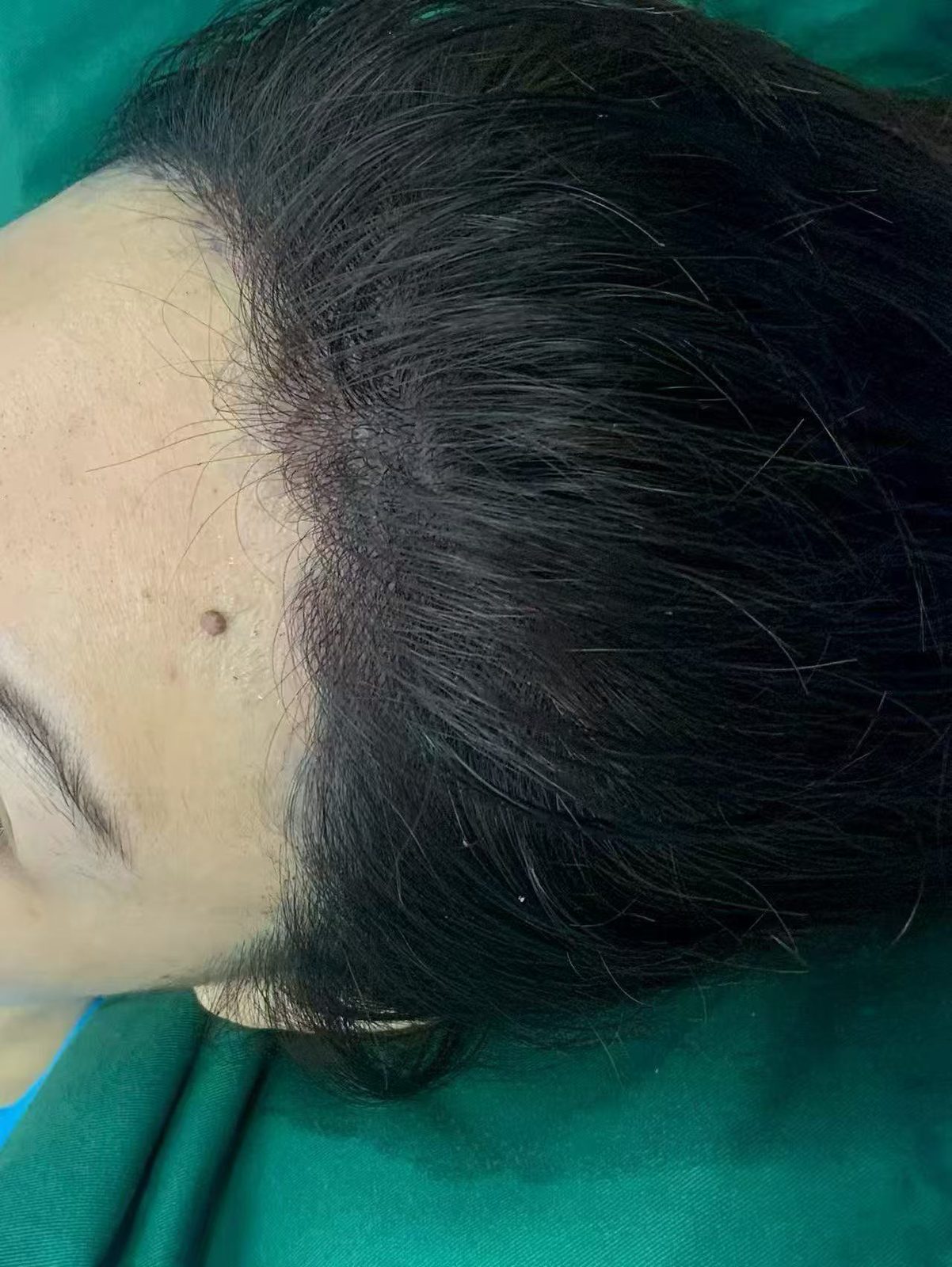 Client 3 after, side hairline view