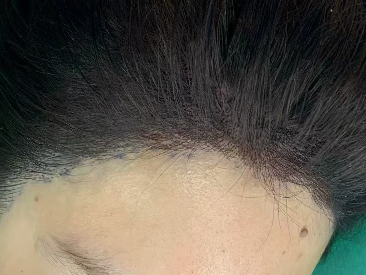 Client 3 after, front hairline view
