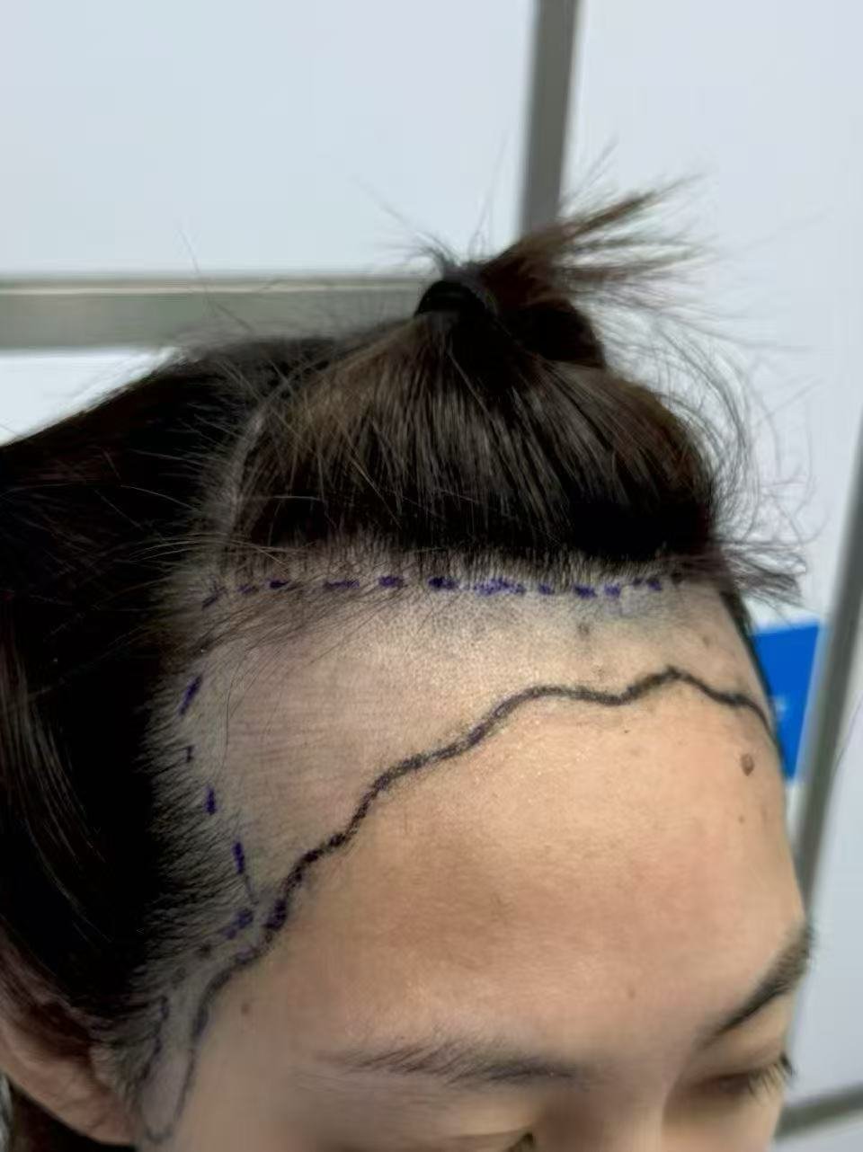 Client 3 before, front hairline view